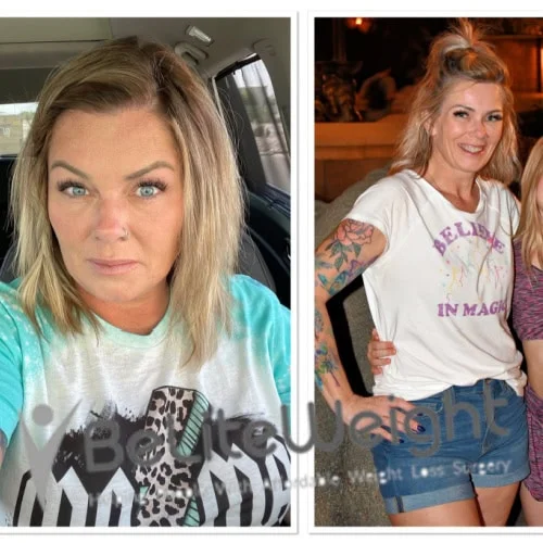 Weight Loss Surgery Gastric Sleeve before and after